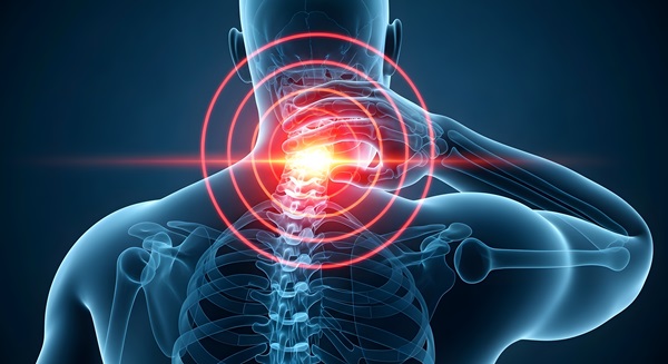 A 3D medical illustration of a human torso from behind, showing a glowing red target symbol centered on the cervical spine (neck) to indicate a whiplash injury. (1681703742)